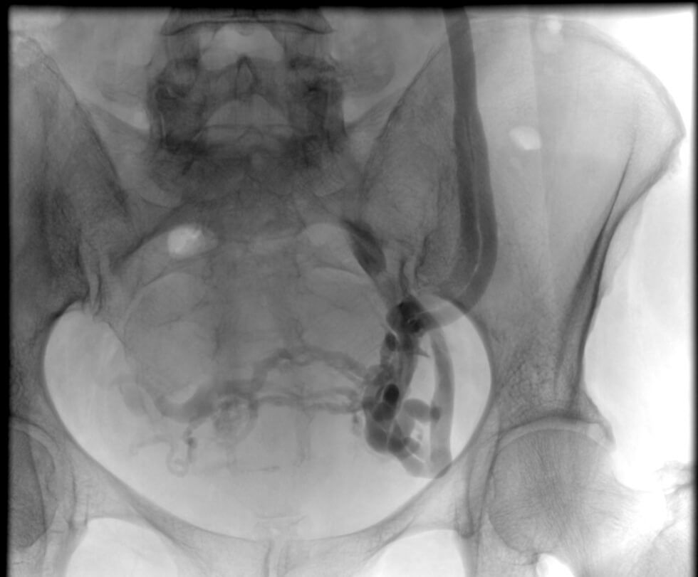 sindrome congestivo pélvico hombre