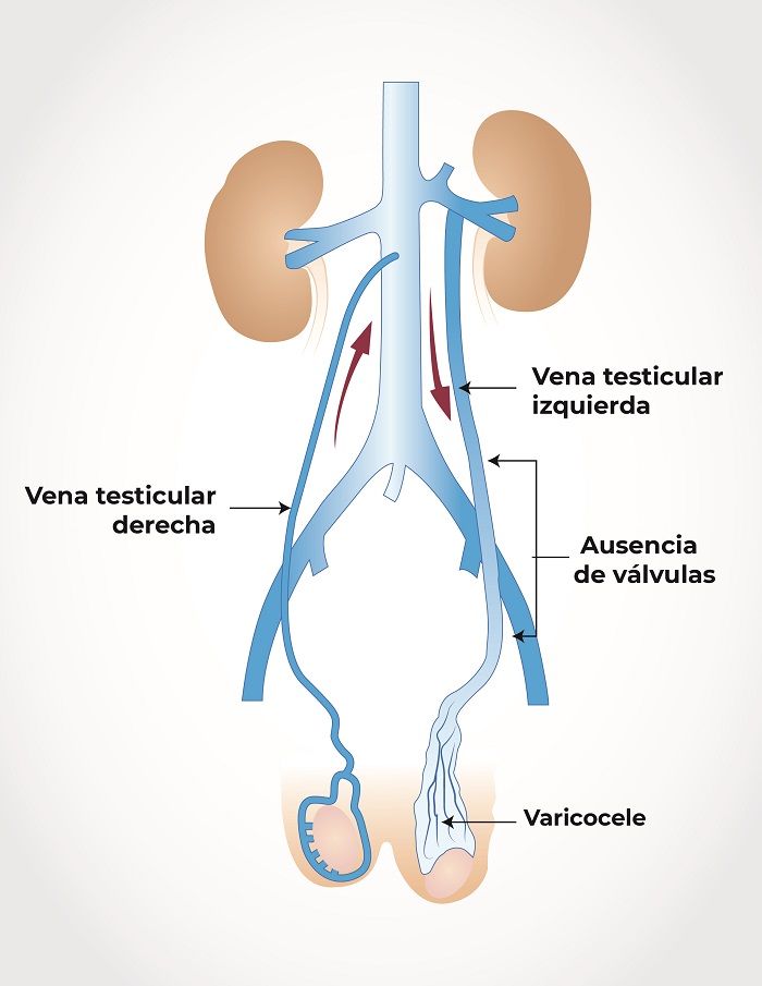 sindrome congestivo pélvico hombre